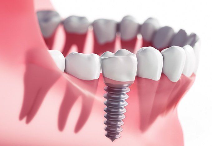 چرا ایمپلنت دندان از دیگر روش‌های جایگزینی بهتر است؟